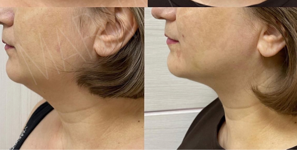 Липолитик для лица