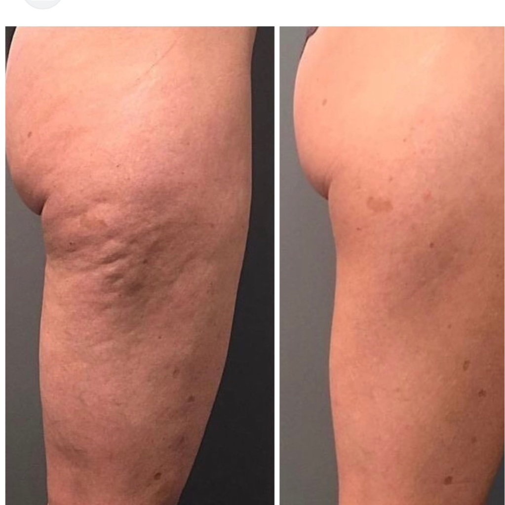 До минус 5 см за сеанс   Ролико-вакуумный массаж с инфракрасным прогревом + RF-лифтинг + вибромассаж