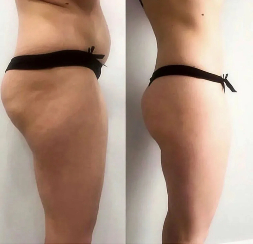 Вакуумный массаж разные зоны за 1 раз