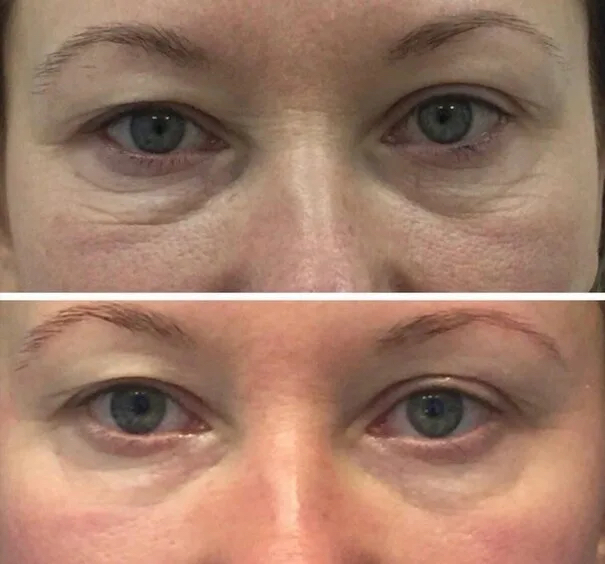 RF лифтинг лица (+ область век)