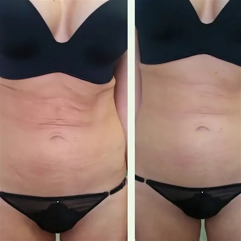 RF лифтинг по телу