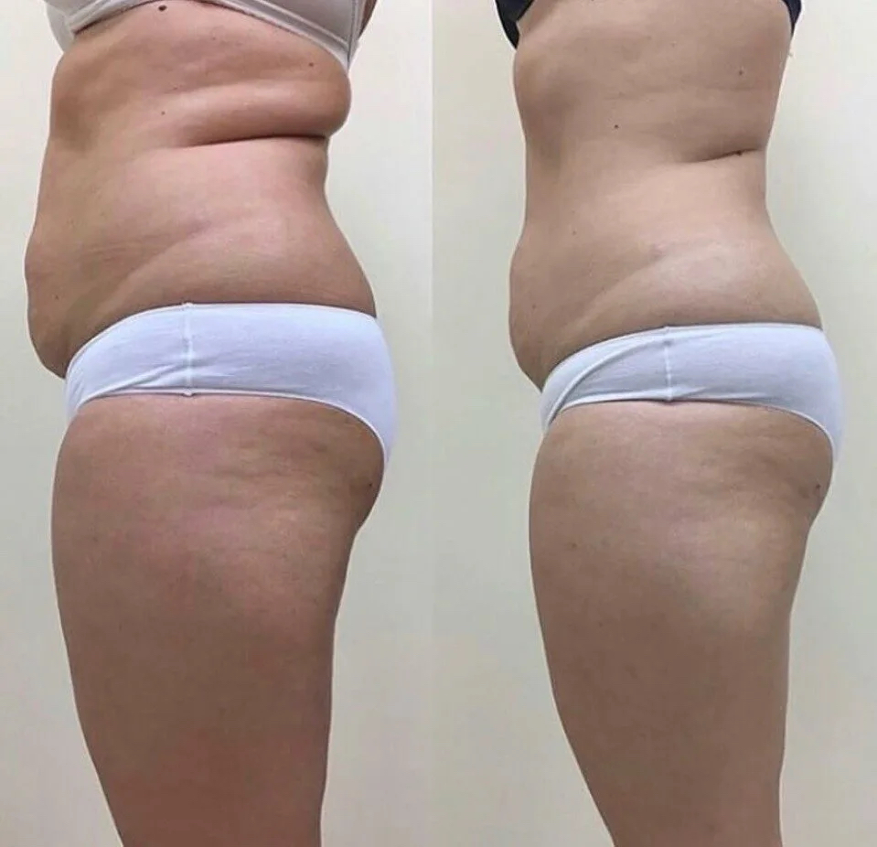 Кавитация ( без инъекционная липосакция) 1 зона