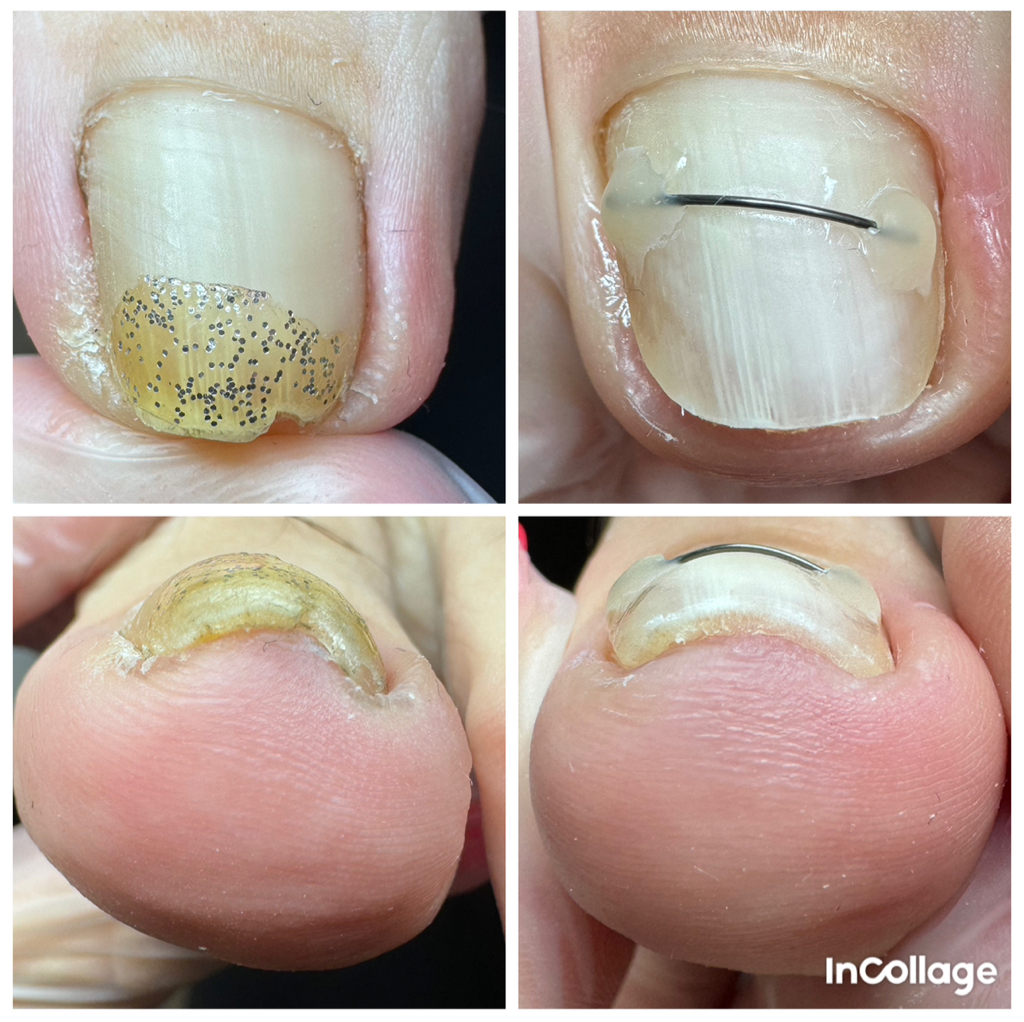 Установка коррекционной системы «Титановая нить», 1 ноготь