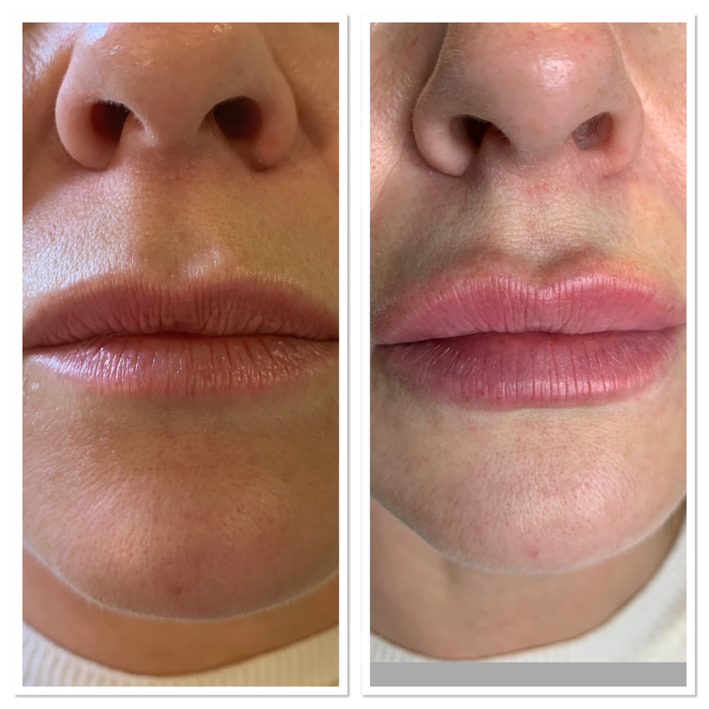 Омоложение губ