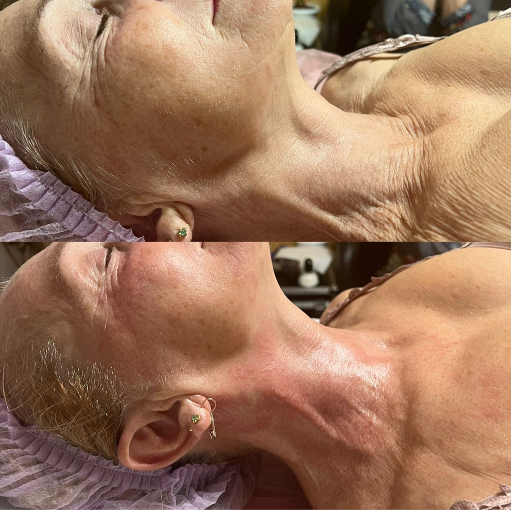 Женщины:   
V lift лицо+шея