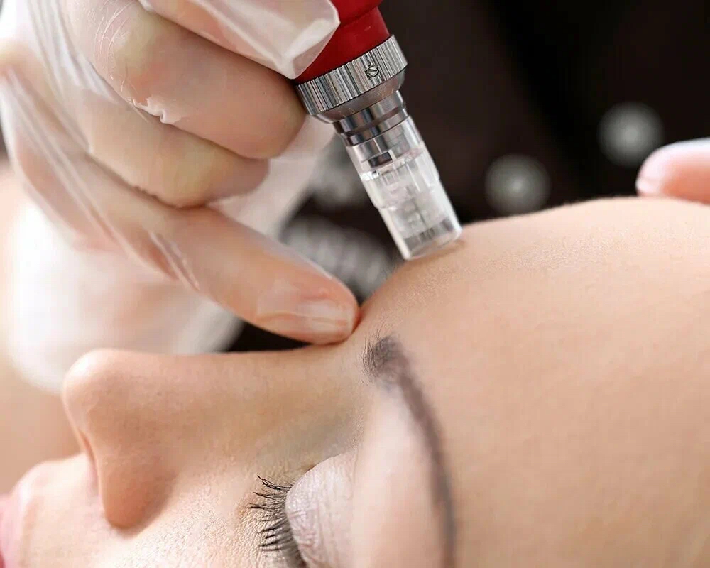 Фракционная мезотерапия с гиалуроновой кислотой