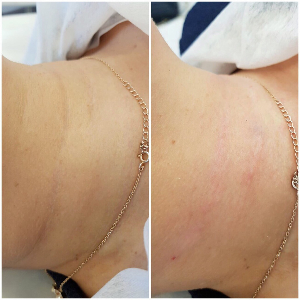 Коррекция шеи (кольца Венеры)