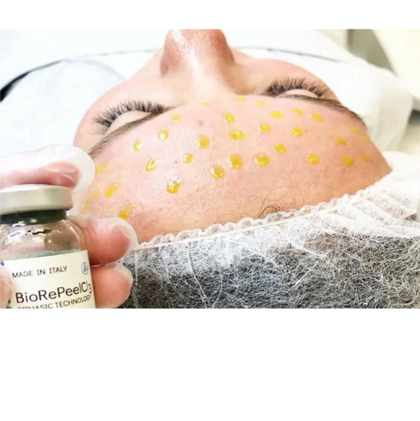 ОП - Химический пилинг BioRePeel (1 зона)