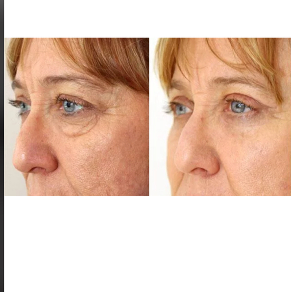 Безоперационная блефаропластика: Нижнее веко