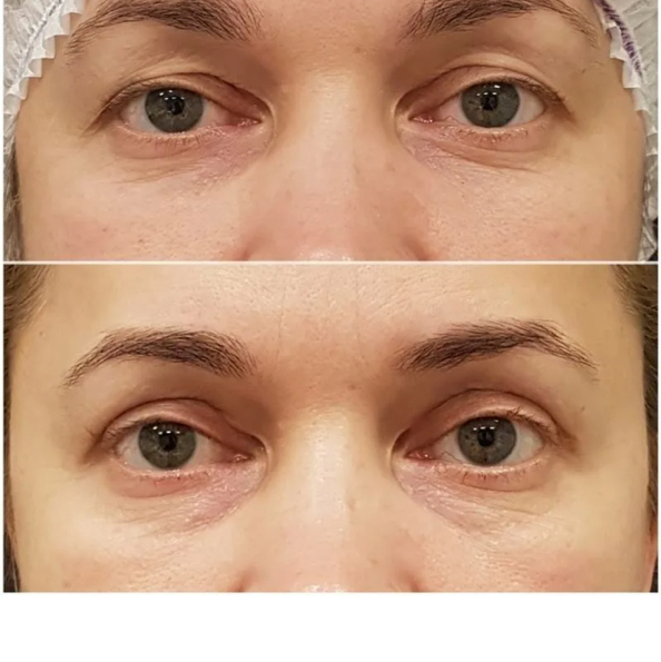 Безоперационная блефаропластика: Верхнее веко + Нижнее веко