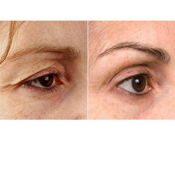 Безоперационная блефаропластика: Верхнее веко