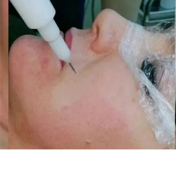 Кисетные морщины (зона вокруг губ)