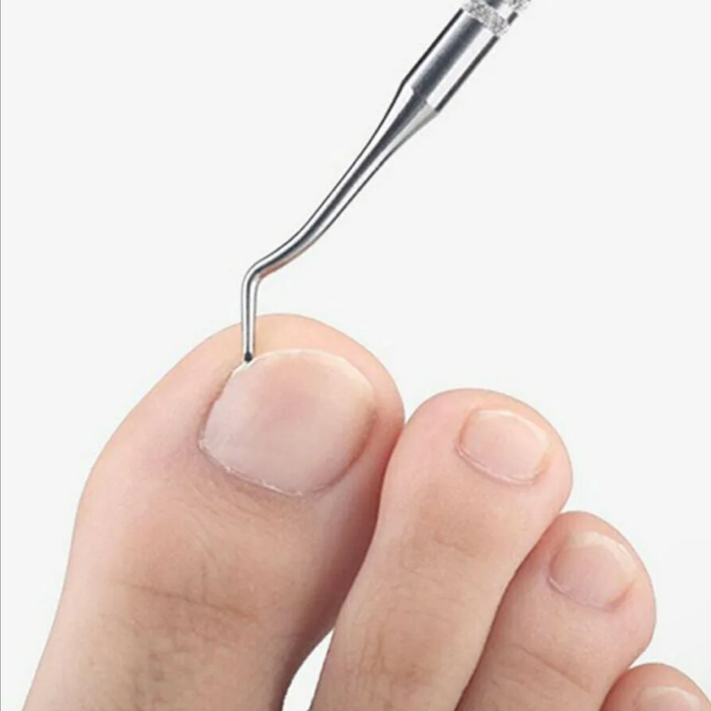 Удаление вросшего ногтя (мозоль)