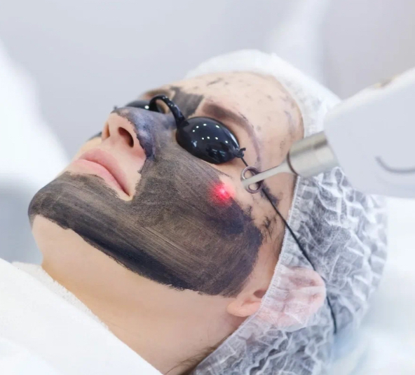 Лазерный карбоновый пилинг/ лицо