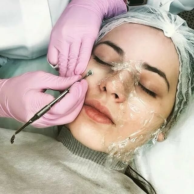 Комплексная чистка лица