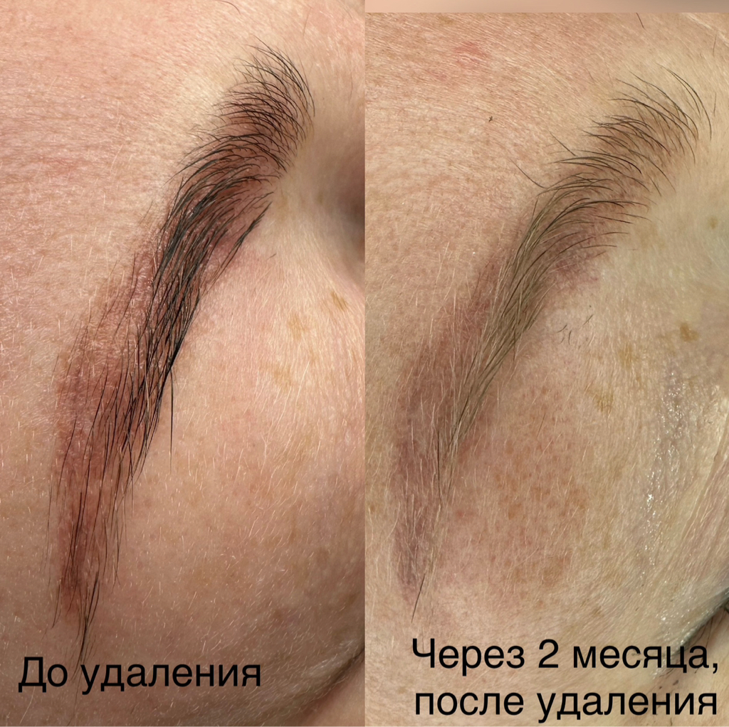 Удаление лазером