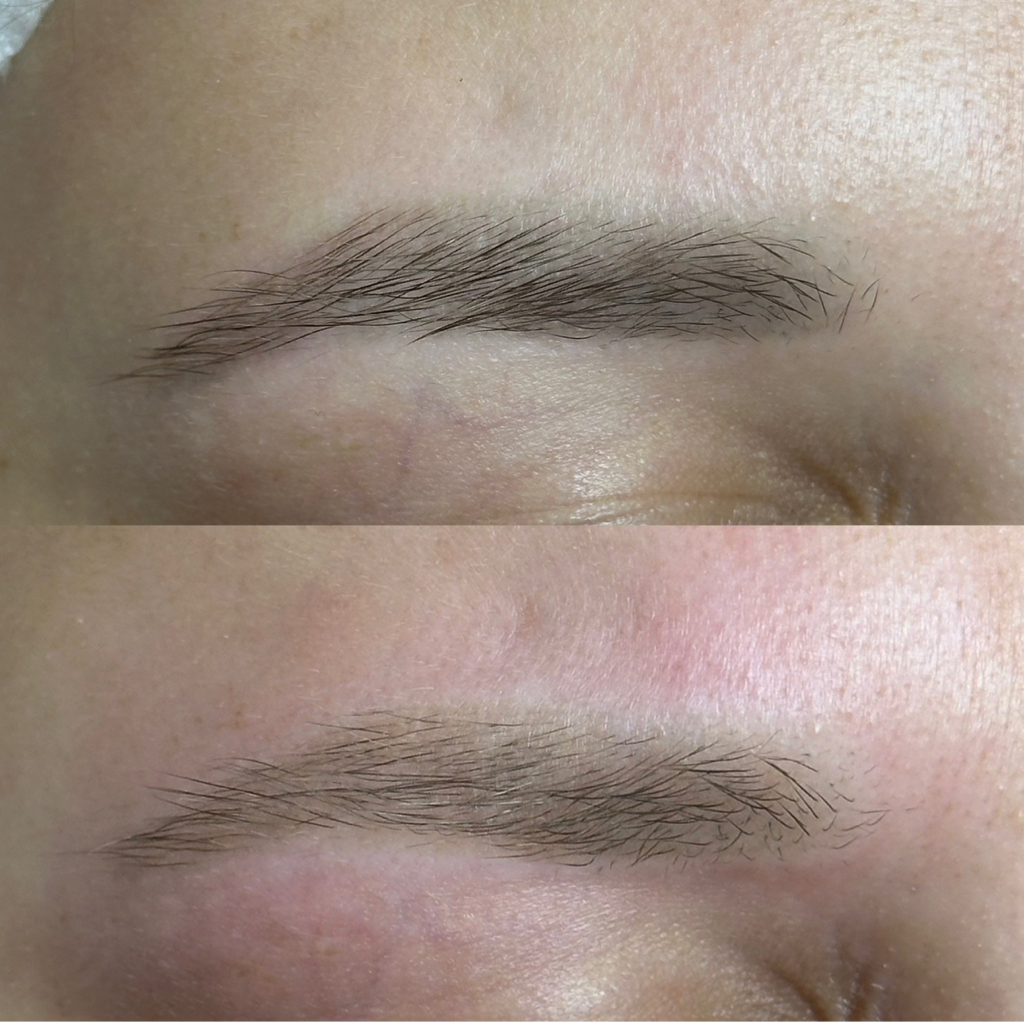 Лазерное удаление бровей