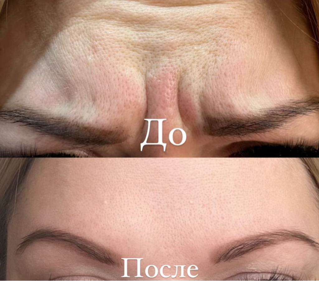 Ботулотоксин