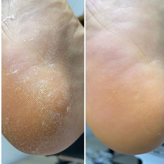 Обработка стопы