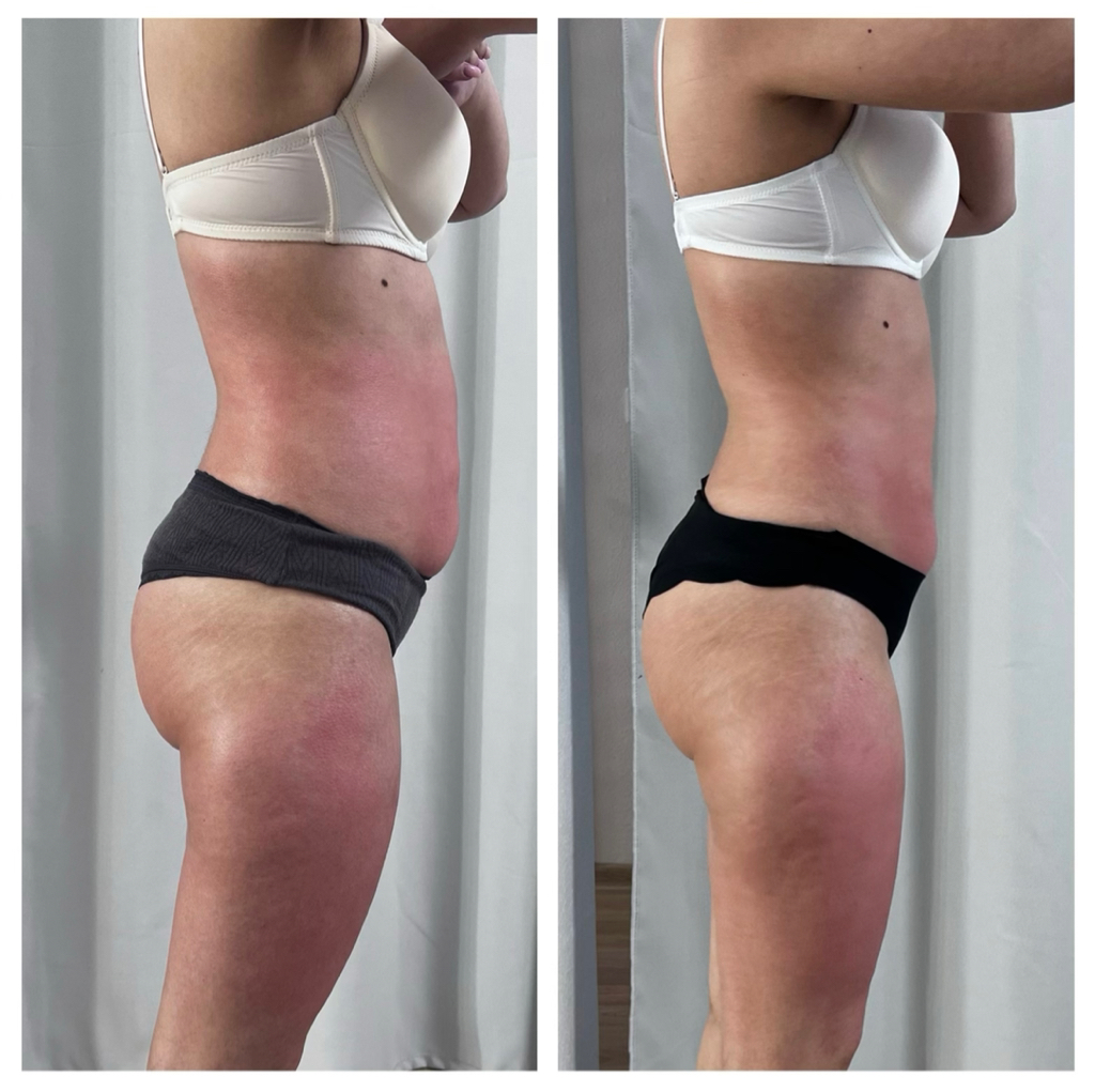 «Тройной комплекс»

1. Микровейв + вакуум/вибро + пресс/ик/паук  
2. Индиба + вакуум/вибро + пресс/ик/паук