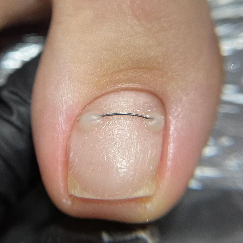 Титановая нить