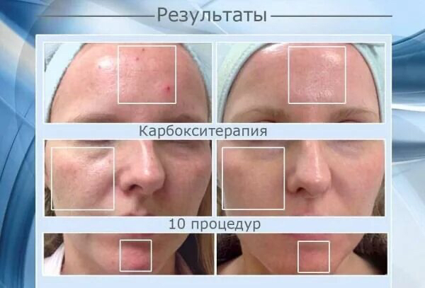 Карбокситерапия СО2