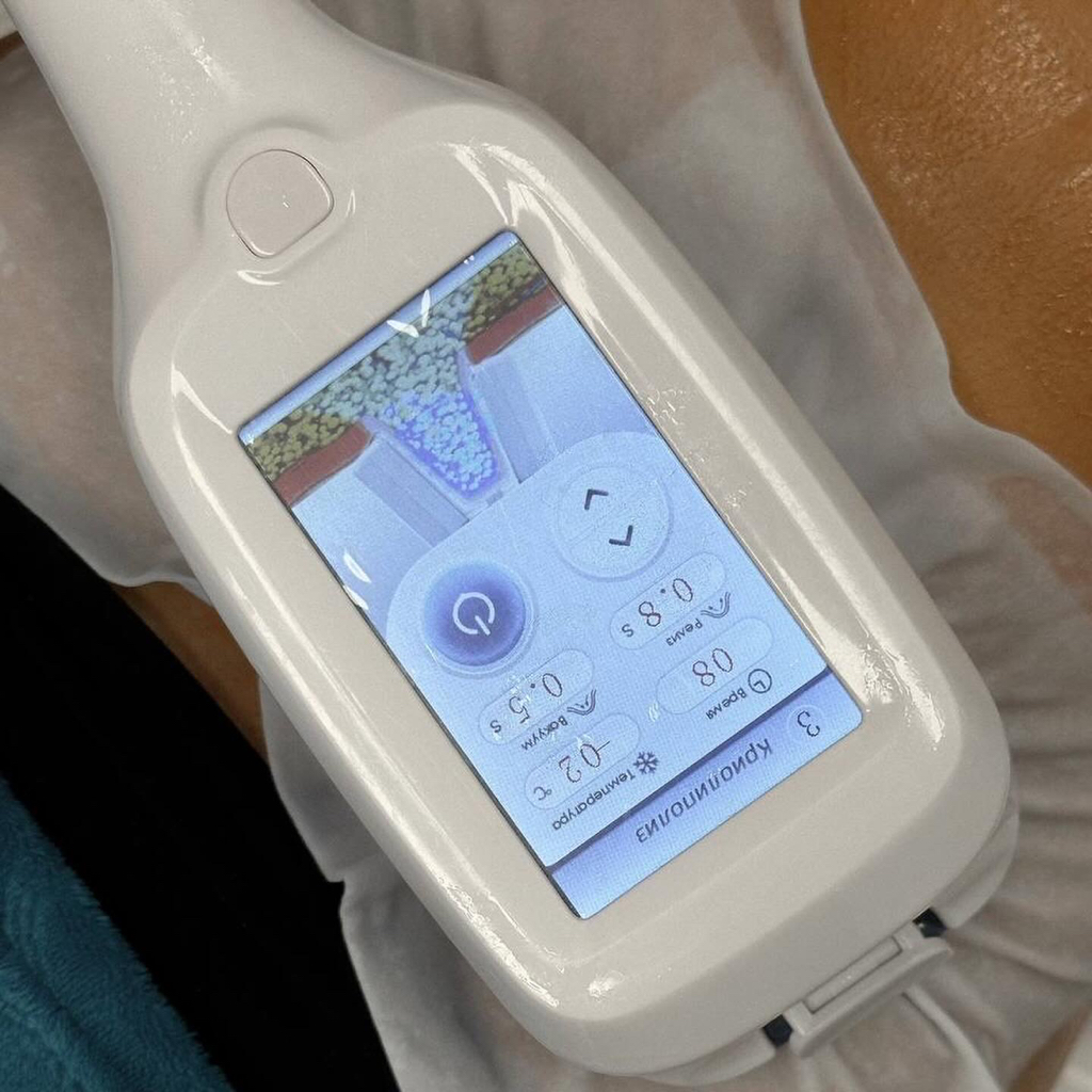 Абонемент: криолиполиз 1-4 насадки