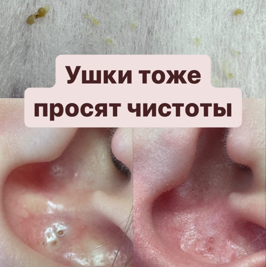 Чистка ушей