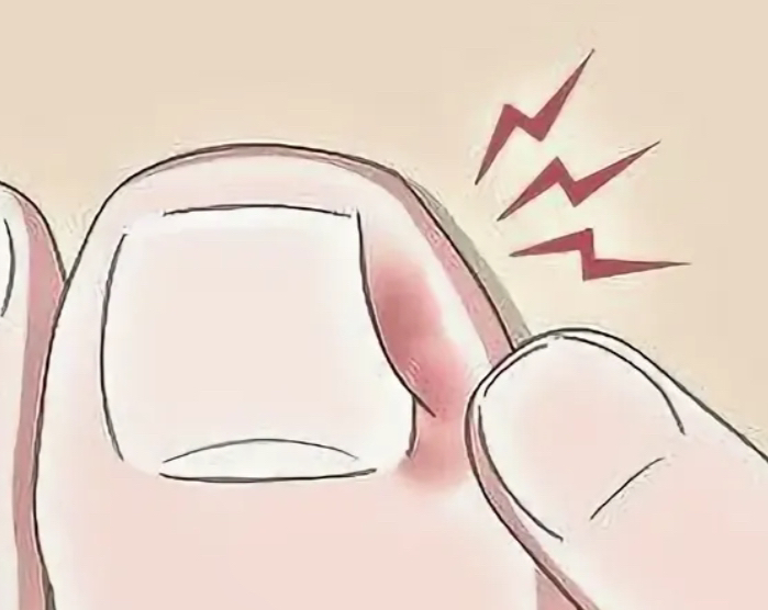 Первичный приём, обработка скрученного или вросшего ногтя+антисептическая повязка ( 1 единица)