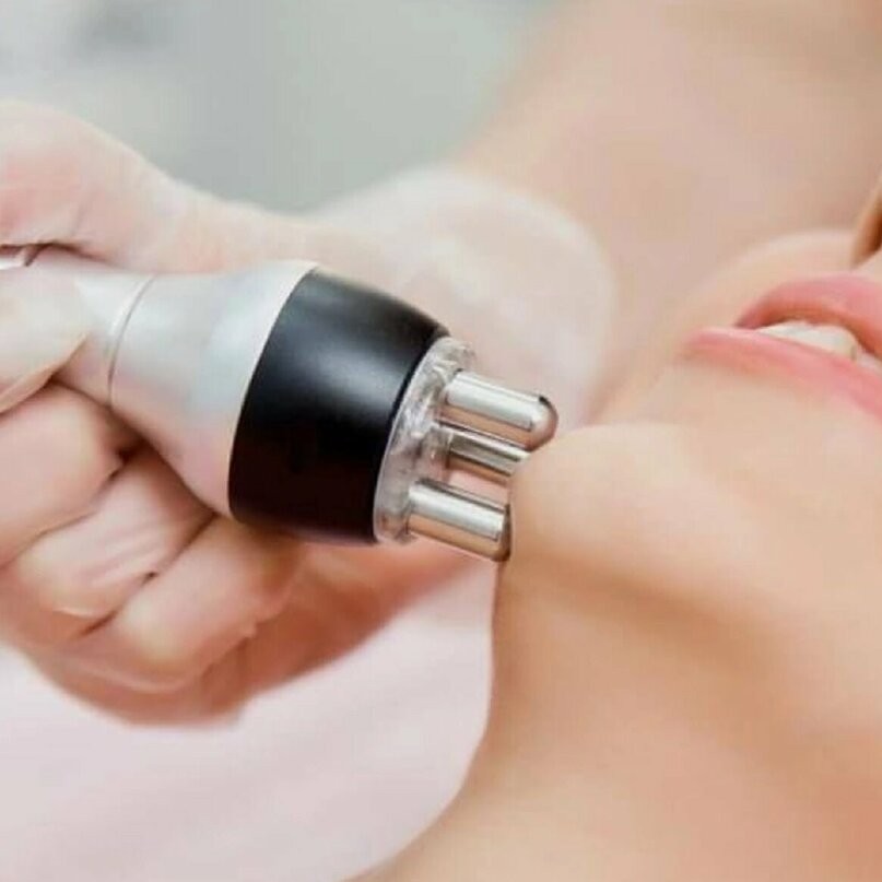 RF- лифтинг лицо