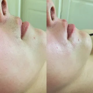 Мужская Депиляция зоны над губой (усики) или Межбровка.