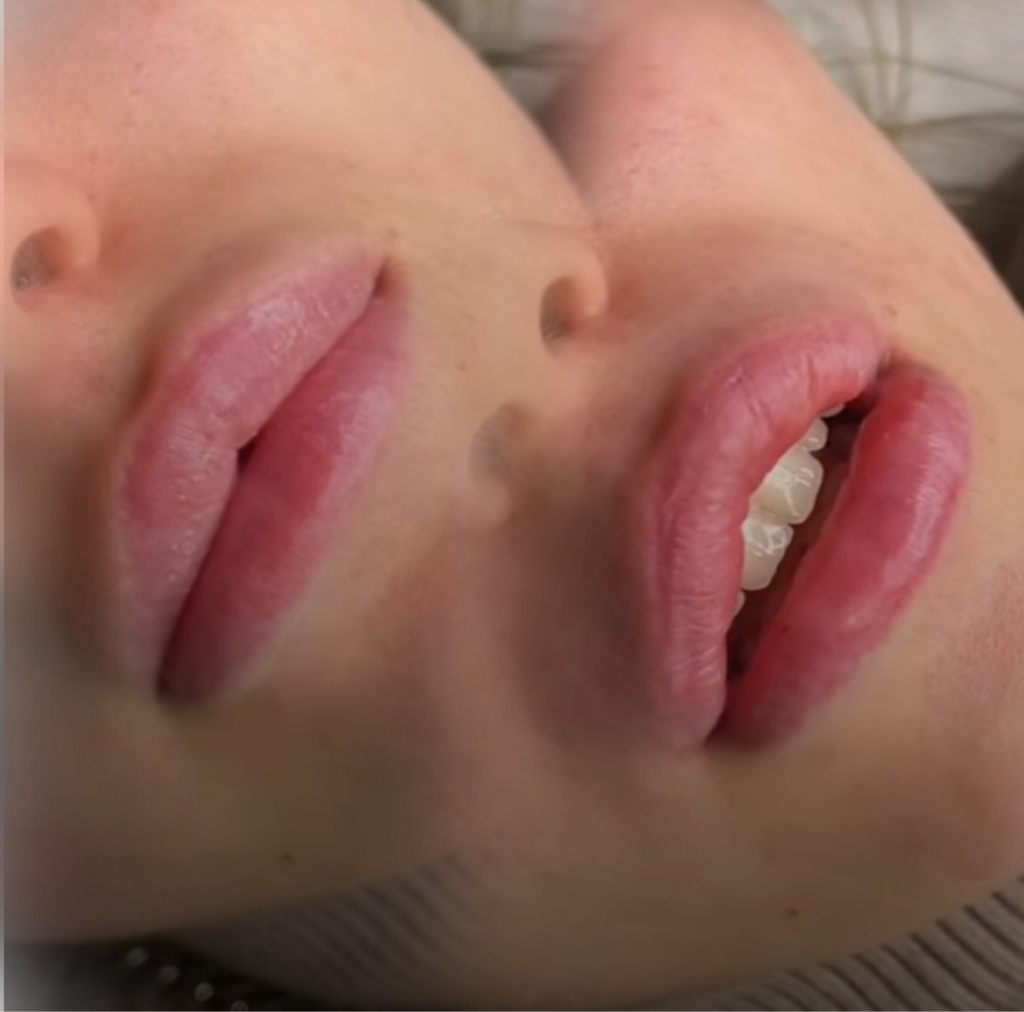 Удаление филлера из губ локальное