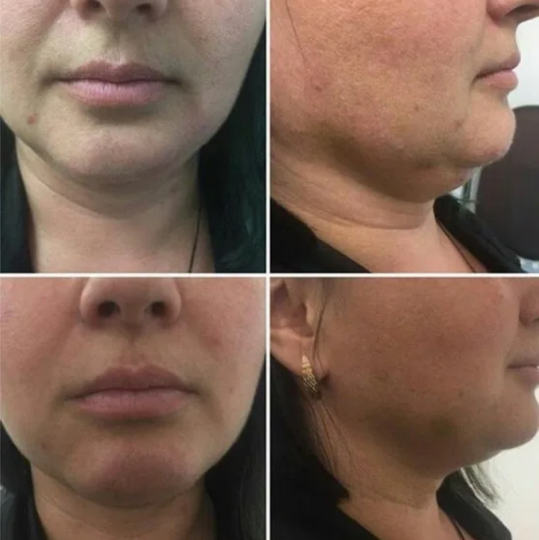 Липолитики лицо 1 флакон