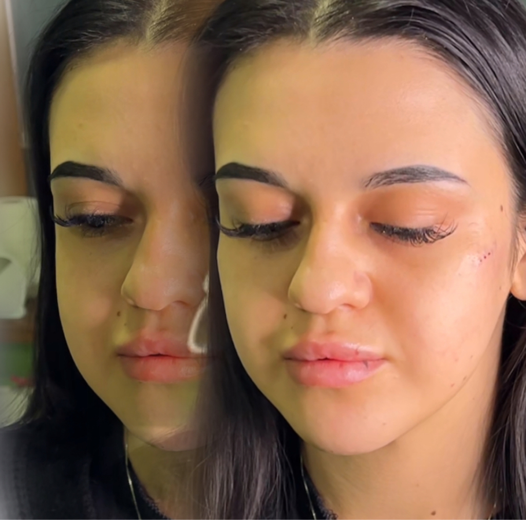 Контурная пластика скул 2мл