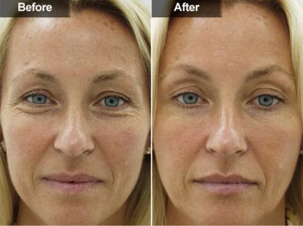 Коктейль Монако (королевский лифтинг)