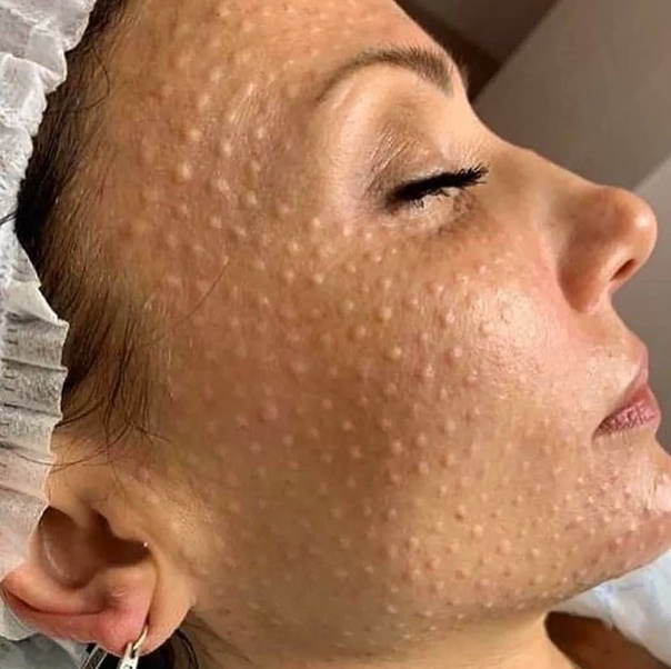 Мезотерапия