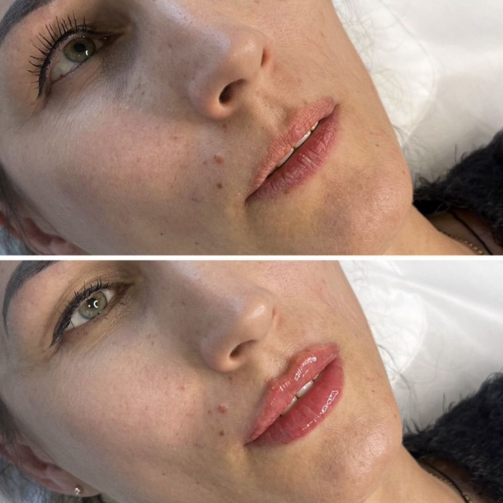 Увеличение губ 0,5мл