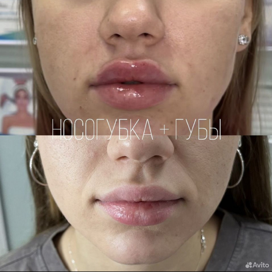 Носогубная складка