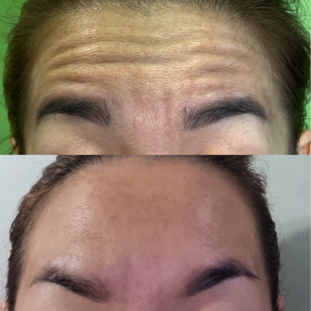 Ботулинотерапия (ботокс)