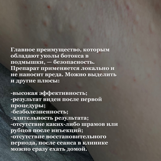 Лечение гипергидроза (чрезмерной потливости)