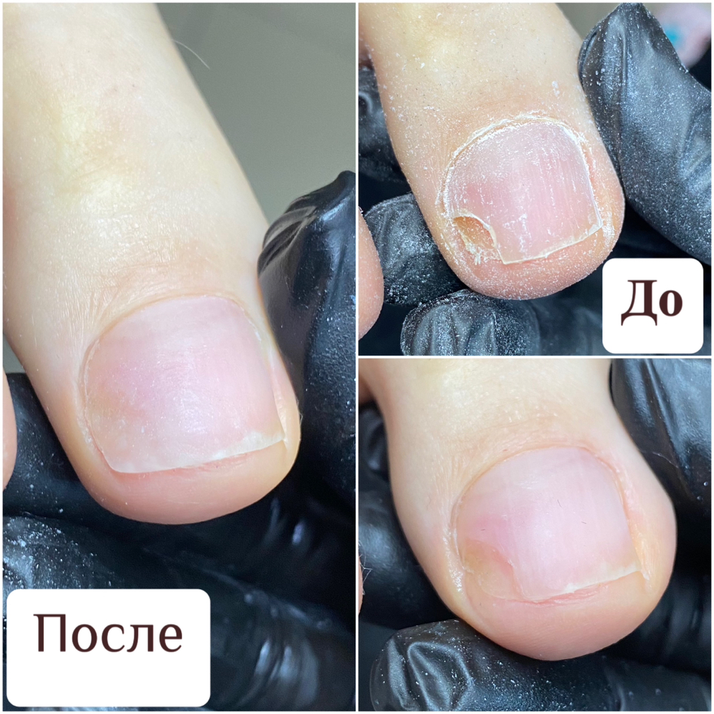 Протезирование ногтевой пластины