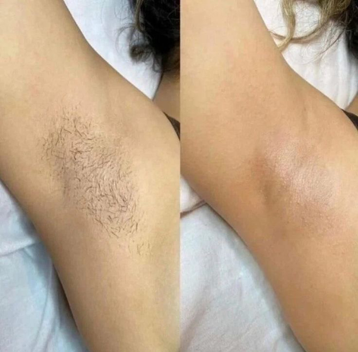 Лазерная эпиляция Подмышки