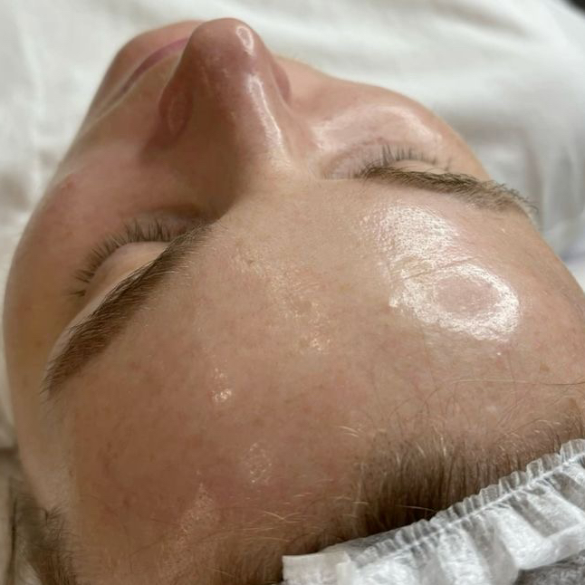 Пилинг Миндальный