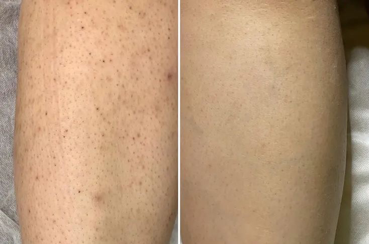 Лазерная эпиляция Голень ( включая колени )