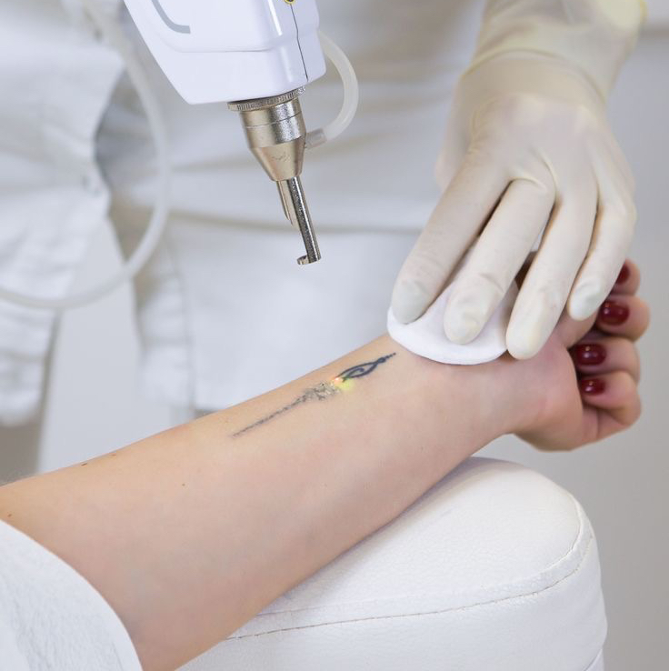 Удаление тату