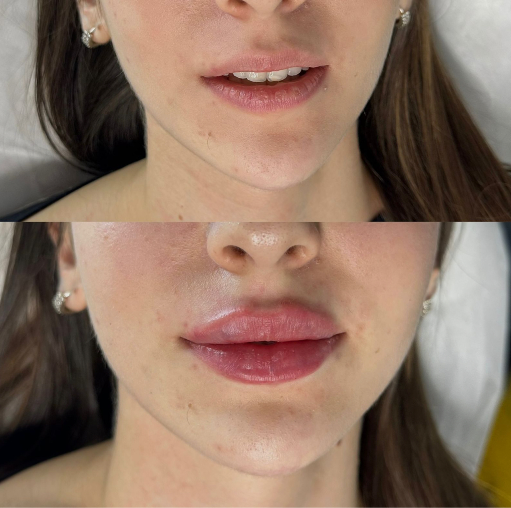 Увлажнение губ