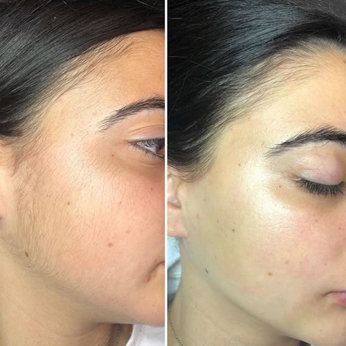 Лазерная эпиляция Бакенбарды