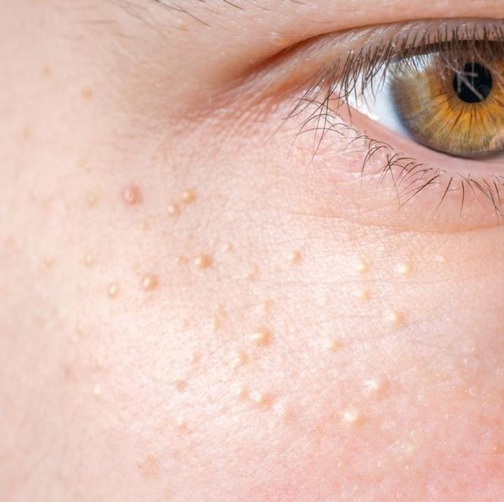 Удаление Жировиков