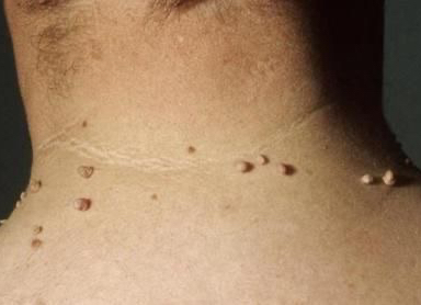 Удаление папиллом