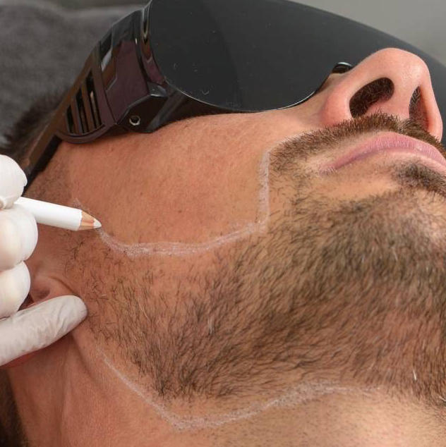 Лазерная эпиляция щеки мужские